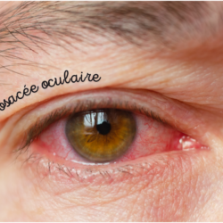 Œil atteint de rosacée oculaire avec rougeurs et inflammation de la paupière