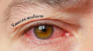 How is ocular rosacea treated?