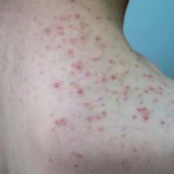 Personne montrant des signes visibles de folliculite sur le haut du dos. La peau présente des boutons rouges, des papules et des pustules inflammatoires caractéristiques de cette affection cutanée. La folliculite est une inflammation des follicules pileux, souvent due à une infection bactérienne ou fongique, provoquant des éruptions cutanées qui peuvent ressembler à de l'acné. Cette image illustre bien les symptômes de la folliculite, qui peut apparaître dans les zones sujettes aux frottements ou à la transpiration, et nécessite des soins spécifiques pour apaiser l'inflammation et prévenir les récidives.