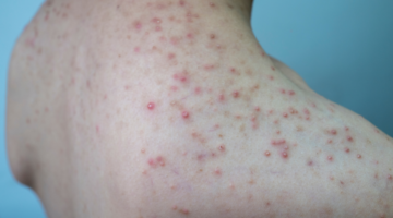 Como tratar a foliculite: tratamento natural