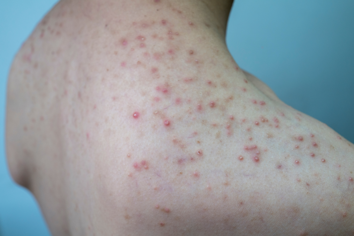 Personne montrant des signes visibles de folliculite sur le haut du dos. La peau présente des boutons rouges, des papules et des pustules inflammatoires caractéristiques de cette affection cutanée. La folliculite est une inflammation des follicules pileux, souvent due à une infection bactérienne ou fongique, provoquant des éruptions cutanées qui peuvent ressembler à de l'acné. Cette image illustre bien les symptômes de la folliculite, qui peut apparaître dans les zones sujettes aux frottements ou à la transpiration, et nécessite des soins spécifiques pour apaiser l'inflammation et prévenir les récidives.