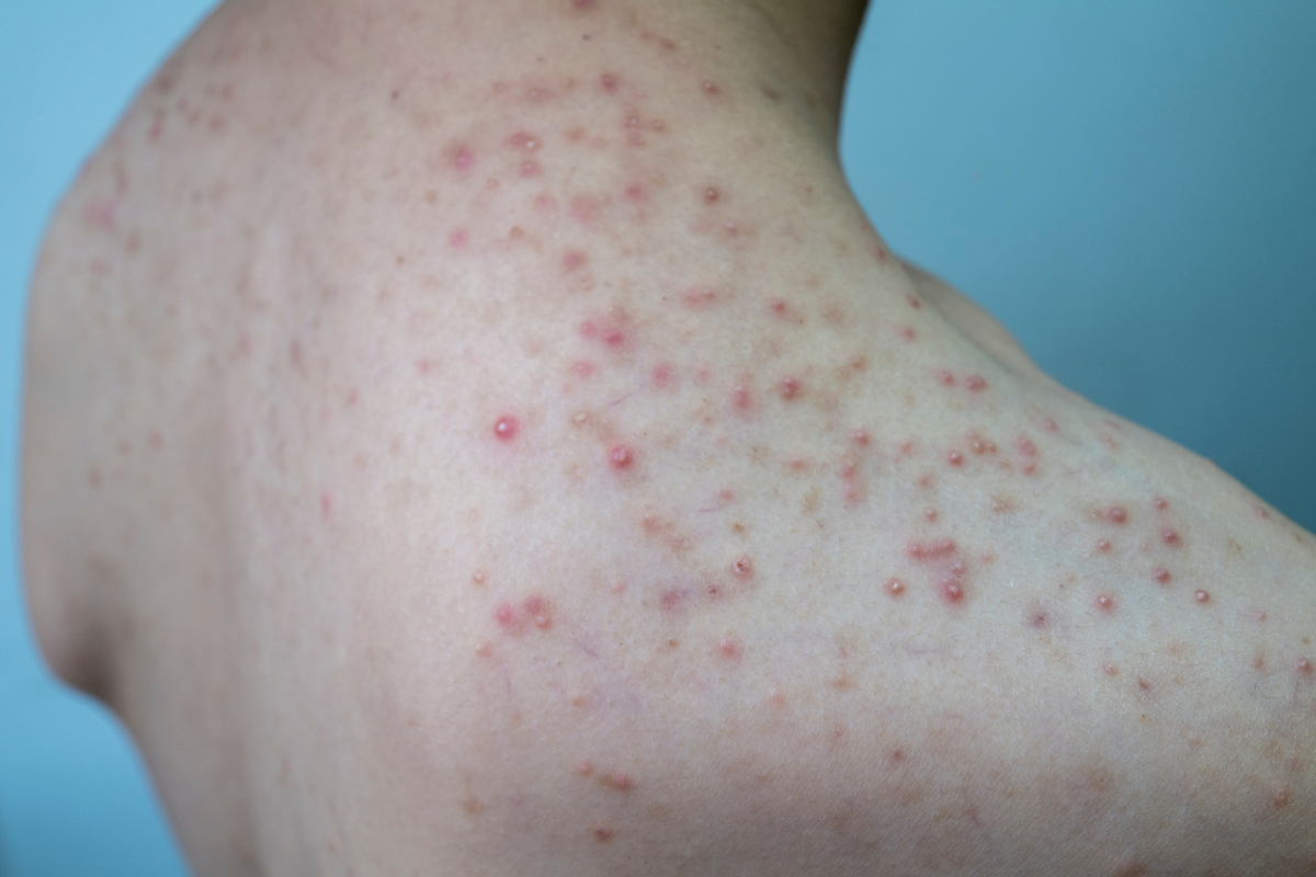 Prevenir Y Tratar La Foliculitis De Forma Natural