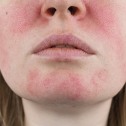 Visage d'une femme présentant des rougeurs et des lésions cutanées caractéristiques de la rosacée oculaire. Cette image illustre les symptômes visibles de la rosacée, tels que l'inflammation et les rougeurs au niveau des joues et du menton. La rosacée oculaire affecte également la surface oculaire et les paupières, pouvant provoquer des démangeaisons et une sécheresse oculaire. Cette condition est souvent liée à des facteurs comme la blépharite, la dysfonction des glandes de Meibomius (MGD), et parfois à la présence de Demodex.