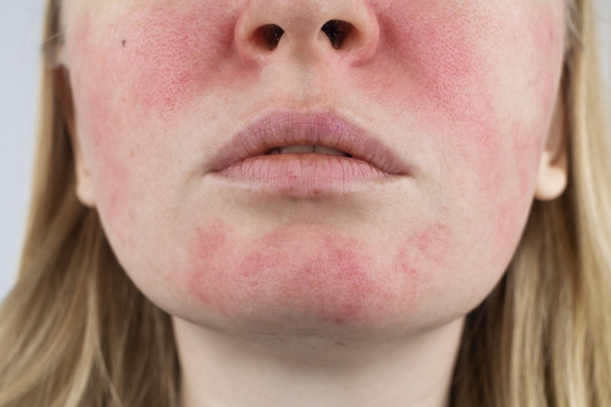 Visage d'une femme présentant des rougeurs et des lésions cutanées caractéristiques de la rosacée oculaire. Cette image illustre les symptômes visibles de la rosacée, tels que l'inflammation et les rougeurs au niveau des joues et du menton. La rosacée oculaire affecte également la surface oculaire et les paupières, pouvant provoquer des démangeaisons et une sécheresse oculaire. Cette condition est souvent liée à des facteurs comme la blépharite, la dysfonction des glandes de Meibomius (MGD), et parfois à la présence de Demodex.