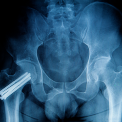 Radiographie d'une hanche montrant une fracture réparée avec des implants, illustrant l'importance de la régénération et de la densité osseuse. Le Shilajit, riche en nutriments essentiels tels que le calcium et les acides fulviques, favorise la cicatrisation osseuse, renforce les os et aide à prévenir l'ostéoporose, soutenant ainsi une meilleure santé osseuse.