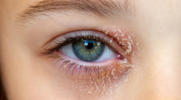 hoe wordt ooglideczeem behandeld?