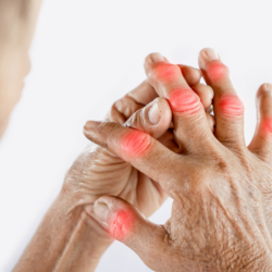 Close-up of hands suffering from joint pain with inflammation of the fingers, a sign of arthritis or osteoarthritis.