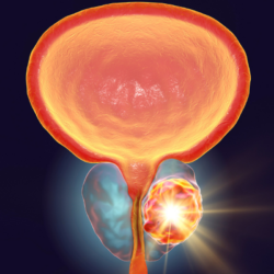 Illustration médicale représentant une prostate hypertrophiée avec une obstruction urinaire, mettant en évidence l'hyperplasie bénigne de la prostate et ses effets sur la vessie.