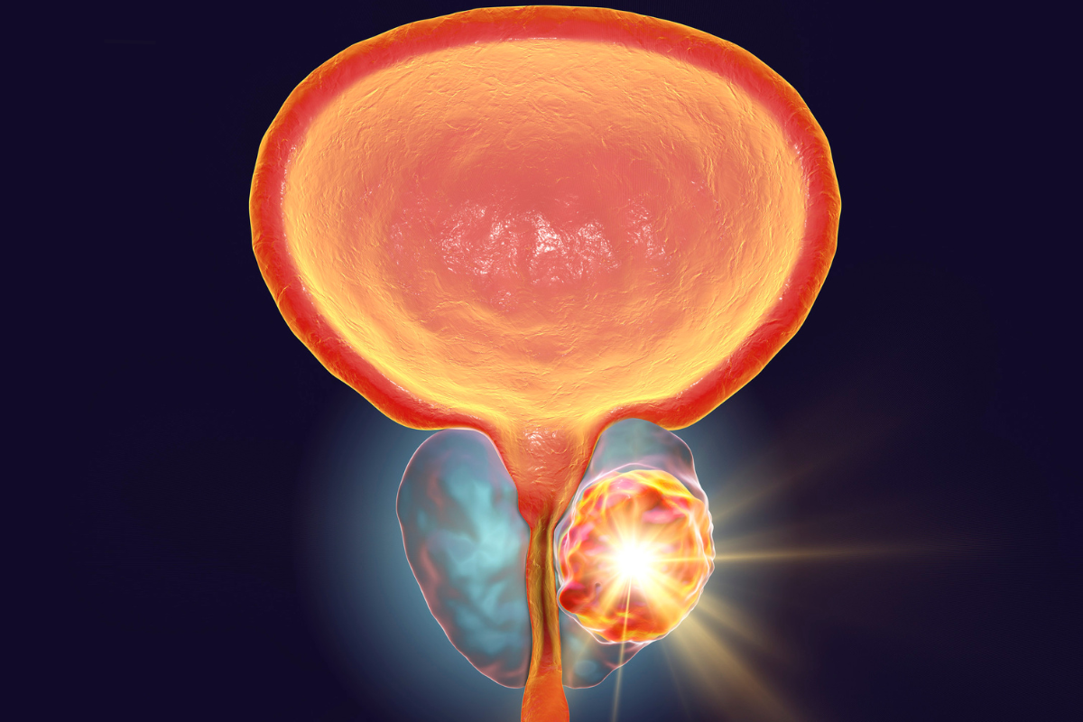 Illustrazione medica che mostra una prostata ingrossata con ostruzione urinaria, evidenziando l'iperplasia prostatica benigna e i suoi effetti sulla vescica.