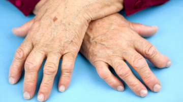 How is osteoarthritis of the hand treated?