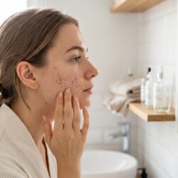 Plan moyen de profil d'une jeune femme dans une salle de bain lumineuse, touchant délicatement sa joue présentant des imperfections d'acné légère tout en se regardant dans un miroir.