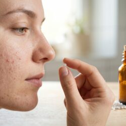 Portrait macro de profil d'une jeune femme avec de l'acné, tenant une granule homéopathique près de sa joue. Flacon ambré, menthe et camomille sur une table en bois en arrière-plan.